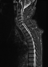 脊髄MRI矢状断像（鴻耀院理事長）